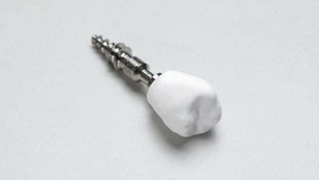 Nanokomposiitista valmistettu valkoinen hammaskruunu.